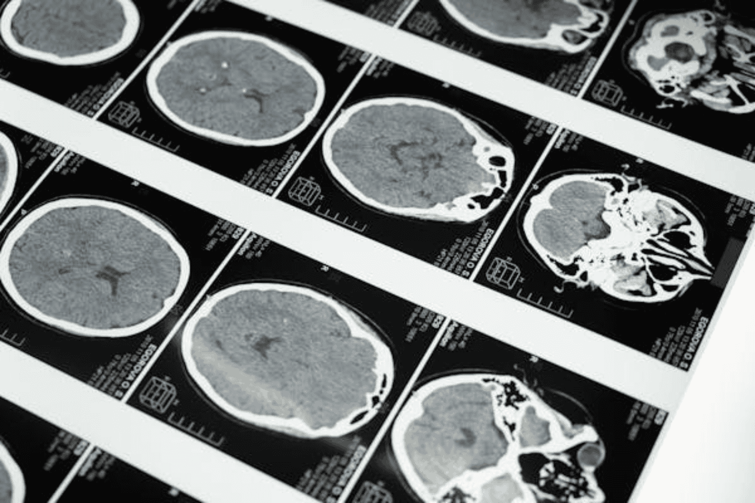 Descubren conexión genética entre dislexia y cambios cerebrales
