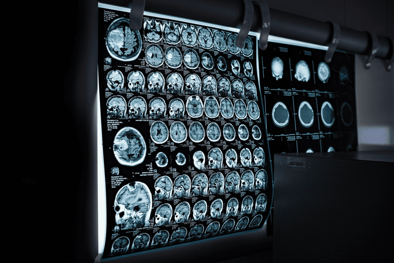 Una nueva esperanza para tratar la epilepsia: descubre el avance que podría cambiarlo todo