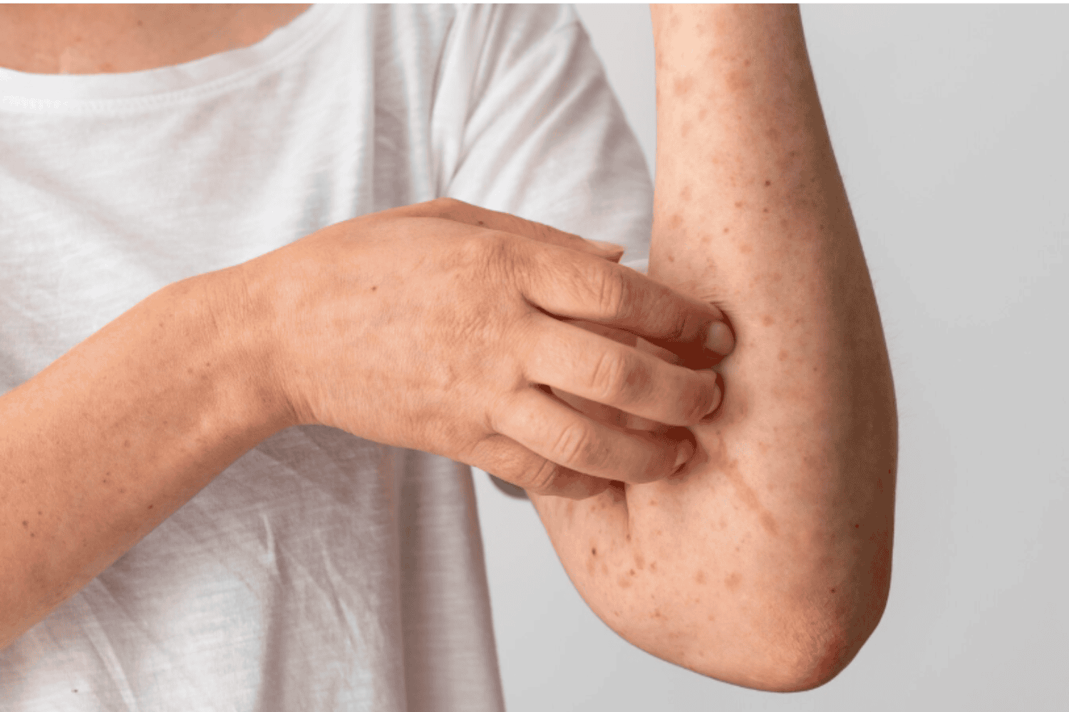 Sarampión en La Plata: el preocupante brote que crece por falta de vacunación infantil