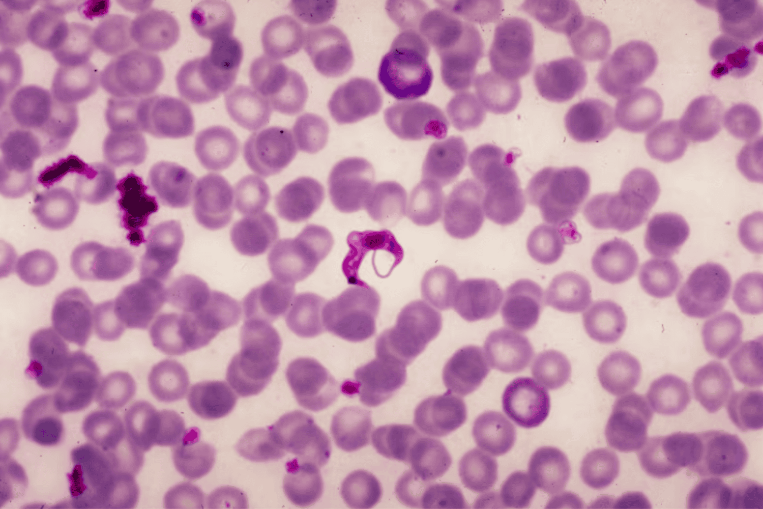 Chagas en Estados Unidos: la transmisión local que preocupa a la ciencia